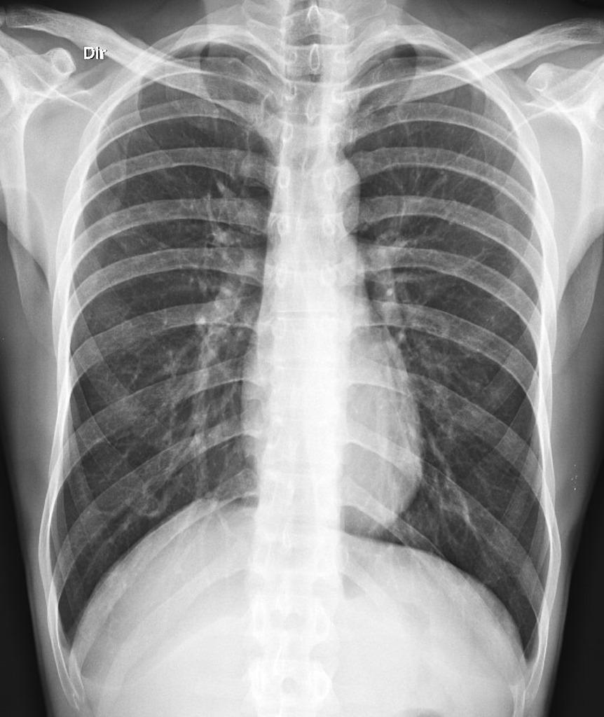 Chest X-ray image Ribs and spine will absorb much of the radiation and appear white or light gray on