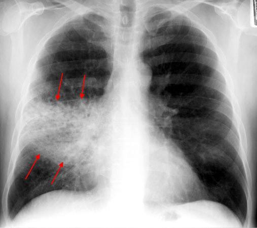 X-ray findings of pneumonia Most commonly manifests as