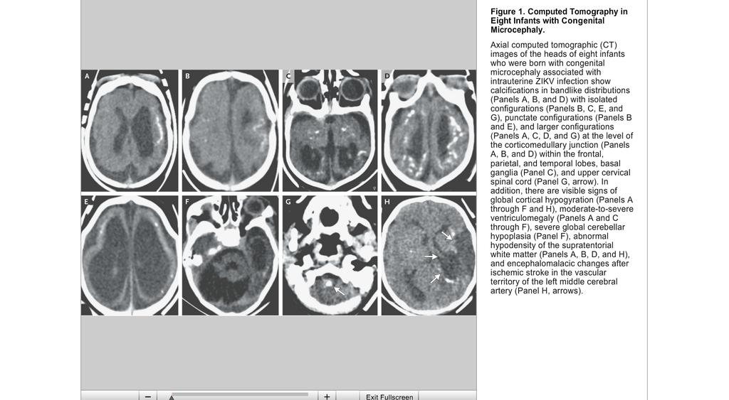 Zika Virus and Microcephaly: CT Findings Photos show CT images of microcephalic infants.
