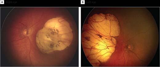 Zika Virus and Ophthalmologic Birth Defects Case series of infants born to mothers with presumed Zika virus infection Chorioretinal atrophy, pigment mottling, optic nerve atrophy de Paula Freitas B,