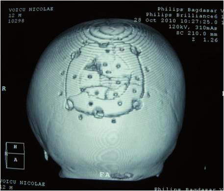 The cranial fracture that involves the inward buckling of the skull bones to resemble a pingpong ball shape, is equivalent to the greenstick fracture occurring at the level of the diaphysis of long