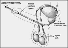 Will a vasectomy affect my sex life? With no change to your hormones, ejaculation or orgasm, there is no reason why a vasectomy should have a negative impact on your sex life.