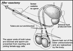 Vasectomy is probably the most effective method of contraception that exists; the failure rate is less than 1%. The sperm-carrying tubes may join together again naturally, but this is rare.