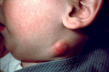 LYMPHADENITIS HISTORY Duration Subacute/chronic - weeks Laterality Associated symptoms (fever, weight loss, fatigue, malaise, conjunctivitis, pharyngitis, dental problems, cough, arthralgia, skin