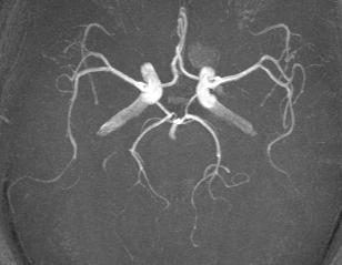 a and b: TOF angiogram (a) and BOLD venogram (b) acquired using the CODEA without the MTC pulse.