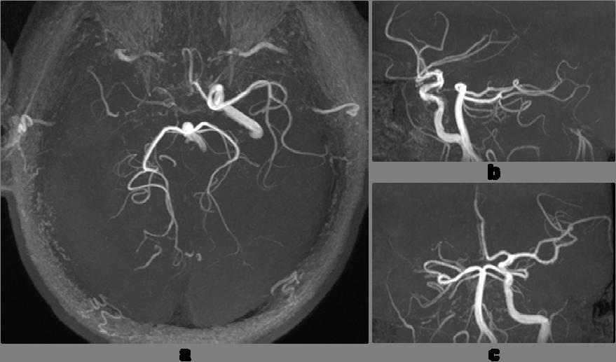 4.2.3 Results One representative CODEA MRA/MRV images are shown in Figures 4.2 and 4.3. Detailed arterial vessels are detected in CODEA MRA including the occlusion of one of the two main arteries (Figure 4.