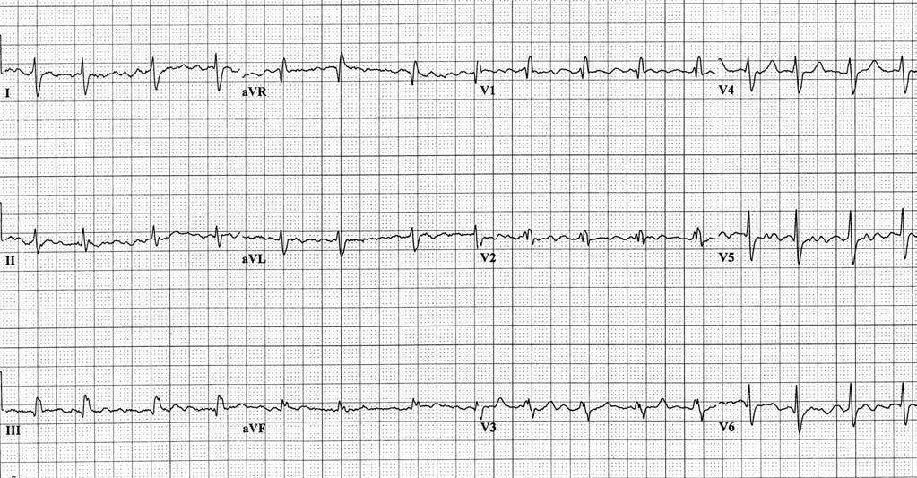 Figure 1. Mrs. Thompson s ECG. What is ASD? Atrial septal defects (ASDs) are the second most common form of congenital heart disease in adults.