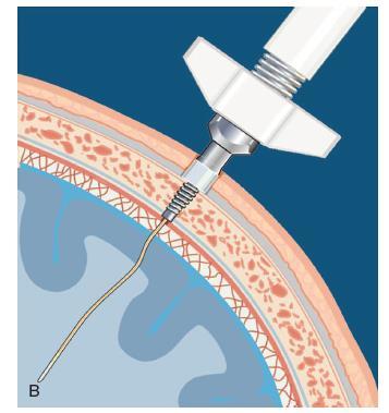Catheter insertion Small intra-parenchymal catheter (0.