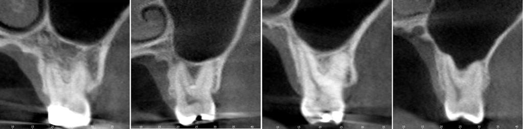 Assessment of the relationship between the maxillary molars and adjacent structures using cone beam computed tomography Materials and Methods The study samples were selected randomly from the