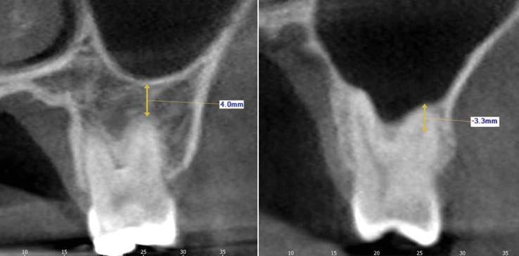 Yun-Hoa Jung et al A B Fig. 3. The distance between the root apex and the sinus floor is measured using CBCT cross-sectional images.