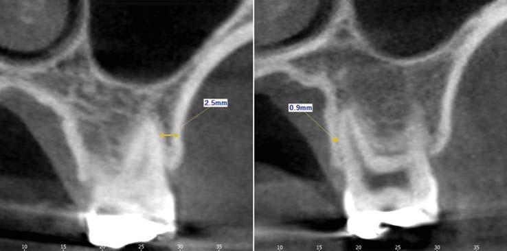 The minimum bone thickness between the root and the alveolar cortical plate is measured using CBCT cross-sectional images.