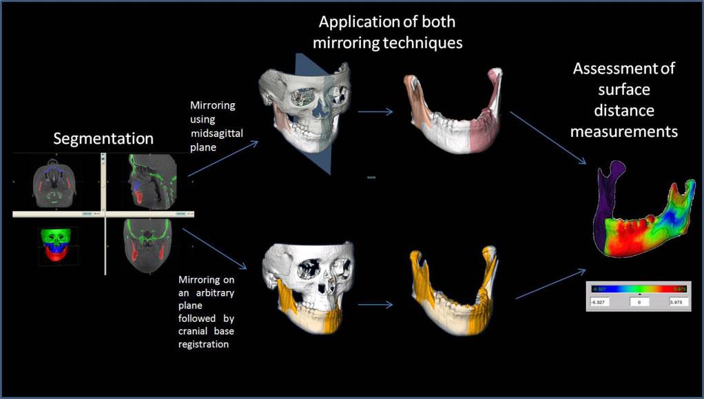 352 A AlHadidi et al Figure 1 Assessment of asymmetry following two different mirroring methods for determining a symmetry plane was presented, using mirroring of the mandible in any arbitrary plane