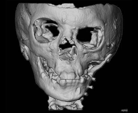 356 A AlHadidi et al the ramus (P 5 0.02), the body of the mandible (P 5 0.03) and the symphysis area (P 5 0.04) when mirroring with the midsagittal plane was used (Figures 4 and 5).