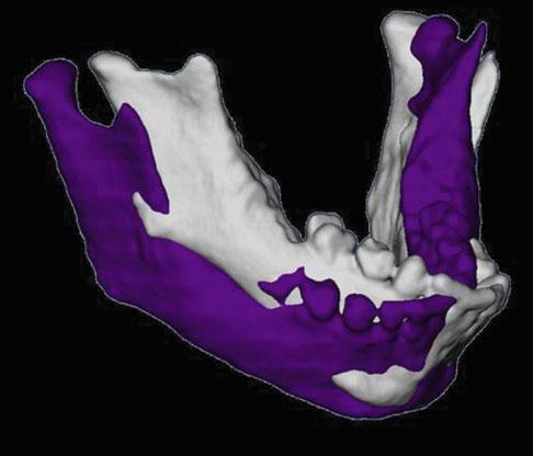 However, quantification of asymmetries using 3D cephalometry heavily depends on the operator s understanding of 3D landmark definition and the ability to reproducibly define those landmarks.