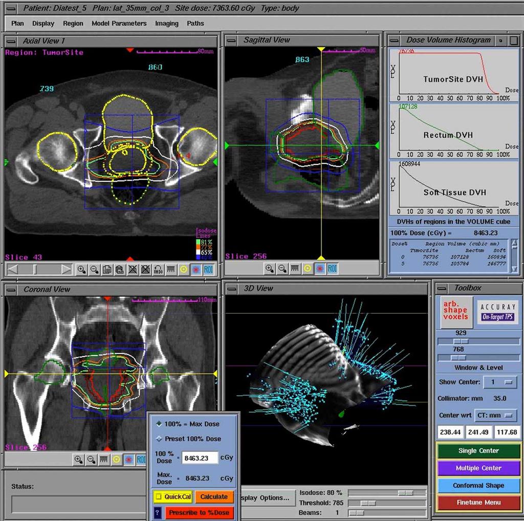 Figure 6. The radiation dose distributions are planned on the CT slices directly. Treatment Delivery On the day of the treatment the patient lies on the couch of the patient positioning system.