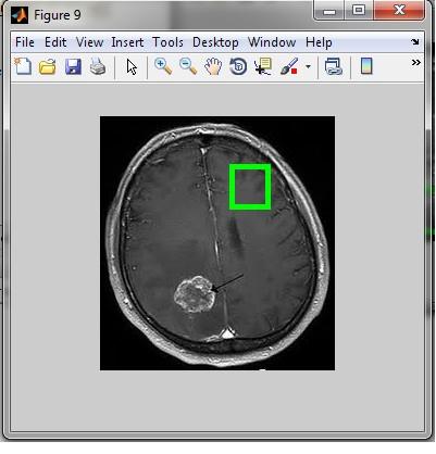 This thing happens as there is same type of tumour image in the template database, so even if it is not a tumour it will be detected. This is known as false positive rate.