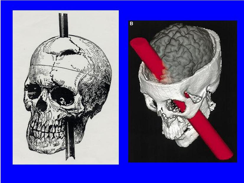 Accidents Phineas Gage Story Personality