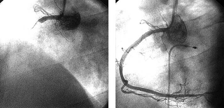 500 Birnbaum, Drew posterolateral region (right coronary artery infarction).