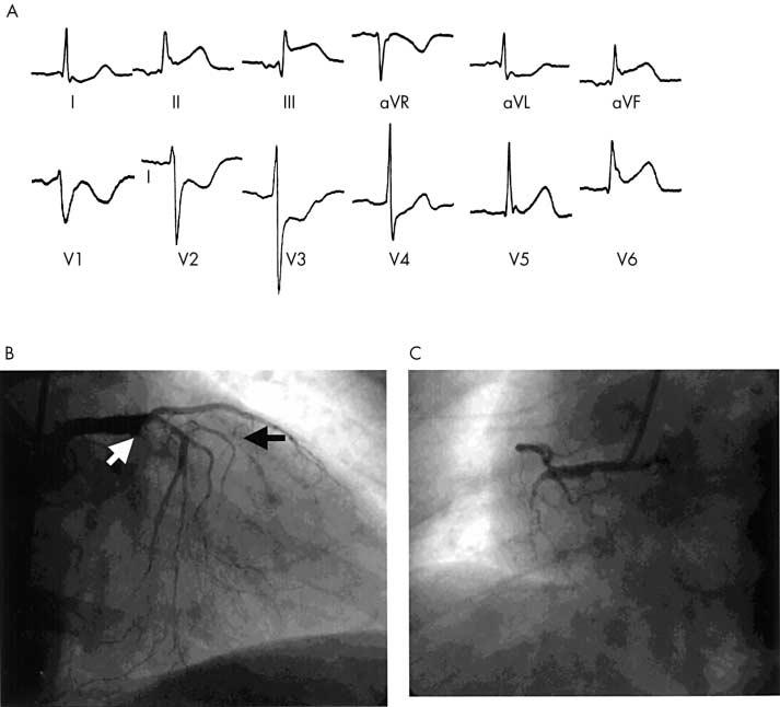 ECG in ST elevation myocardial infarction 491 Box 1: Variables that affect the immediate prognosis in acute myocardial infarction Size of the ischaemic myocardium at risk.