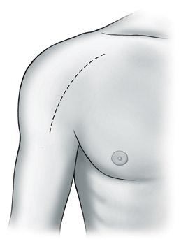 Detailed OPERATIVE TECHNIQUE Indications The Equinoxe Shoulder System is indicated to relieve pain and restore function in skeletally mature individuals with degenerative diseases or fractures of the