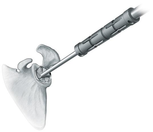 The glenoid labrum is excised and an anterior and inferior capsular release is performed both for exposure and soft tissue mobilization.