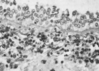 323:1033, 1990 Eosinophils and Asthma
