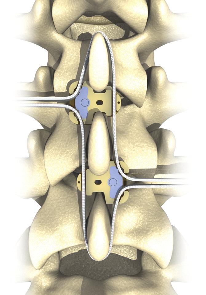 Two-level implants 2 1 2 The principle of the technique remains the same. It is, however, recommended to place the two UniWallis Spacers in opposing directions (fig.
