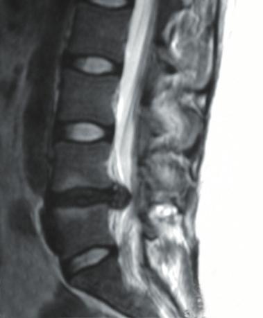 Indications/Contraindications The UniWallis Posterior Dynamic Stabilization System treats low-back pain that accompanies degenerative lesions of grade II, III and IV (Pfirrmann MRI classification)