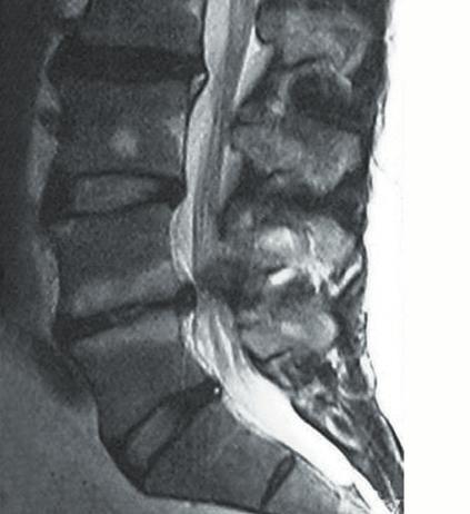 disease at a segment adjacent to fusion Modic 1 Lumbar canal stenosis (1) Pfirrmann CWA, Metzdorf A, Zanetti M, Hodler J, Boos N (2001) Magnetic resonance classification of lumbar intervertebral disc