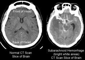 Types of Traumatic Brain
