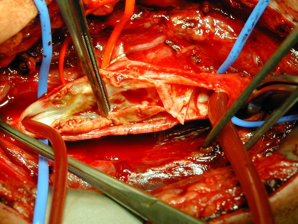 site and removes the plaque Carotid,