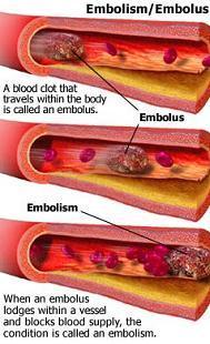 Other Risks of Arteriosclerosis Thrombus: formation of a blood clot