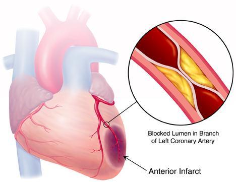 Other Risks of Arteriosclerosis Emboli in the arterial circulation can lead to