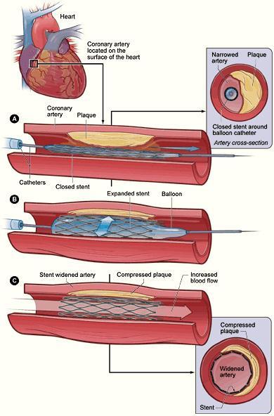 Treatments for Coronary Artery