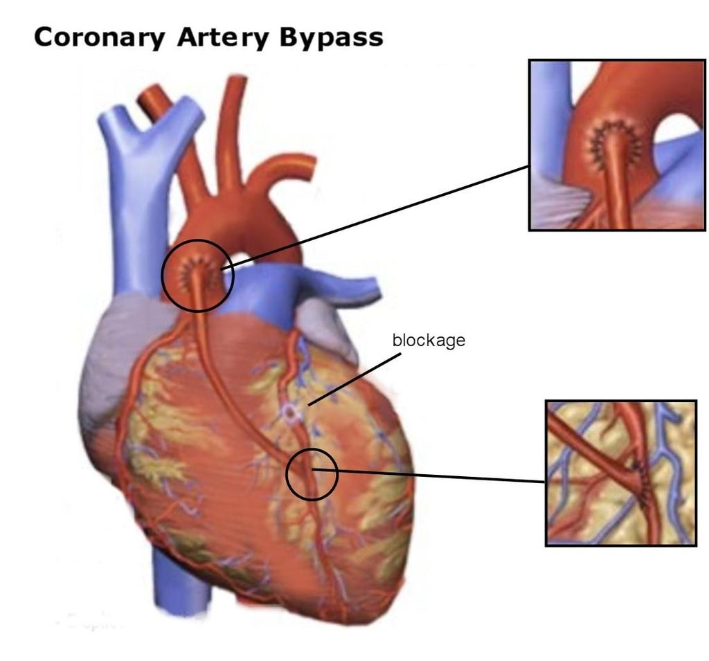 Coronary Angioplasty (PTCA)