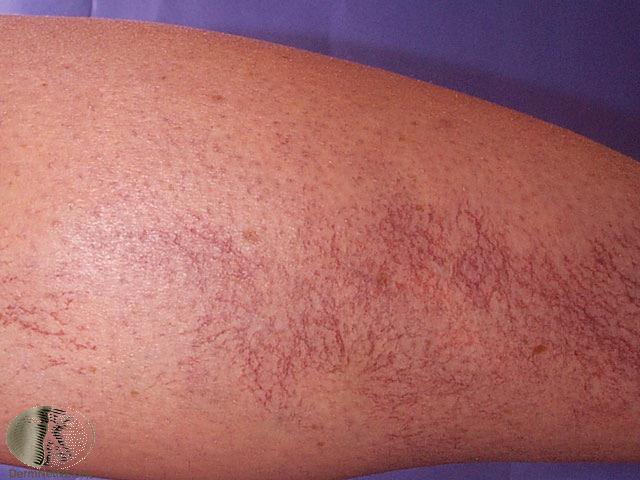 Vericose Veins Varices: occurring in the