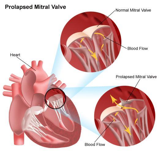Mitral Valve Prolapse (MVP) The leaflets of the mitral valve