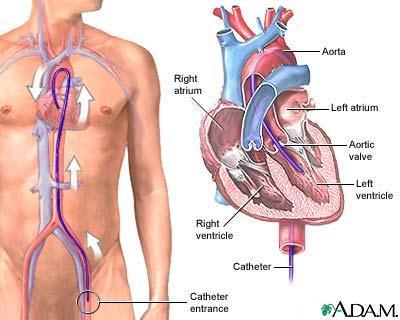 Cardiac Catheterization (CC) Passage of a catheter into the heart