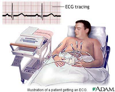 Electrocardiogram (ECG, EKG) Graphic line recording that shows