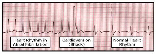 Cardioversion Procedure to restore normal rhythm of the heart by