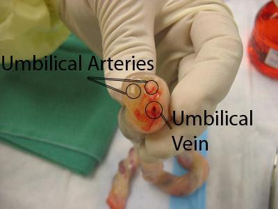 Fetal Circulation Umbilical Cord: contains 2 arteries & 1 vein Umbilical Arteries: