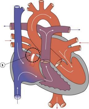 Fetal Circulation From the Left Atrium blood moves through the mitral