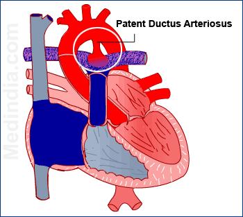 Newborn Heart Conditions Patent Ductus Arteriosus: Failure of the DA
