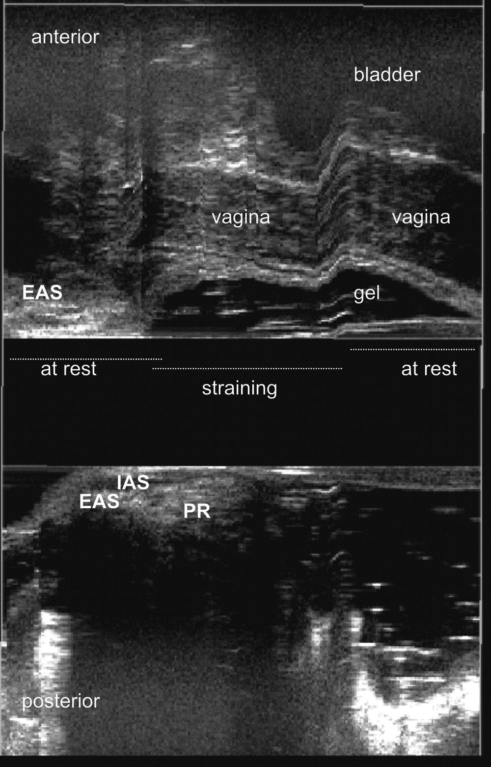 DISEASES OF THE COLON &RECTUM VOLUME 54: 6 (2011) 689 FIGURE 2. Scan 3 with gel inserted into the rectum (sagittal plane). Normal examination. Vagina is pushed downwards and backwards.
