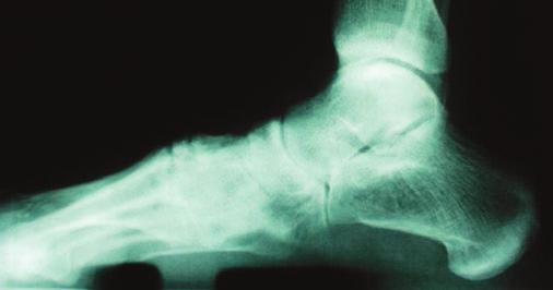 collapsed arch on the patient s left foot.