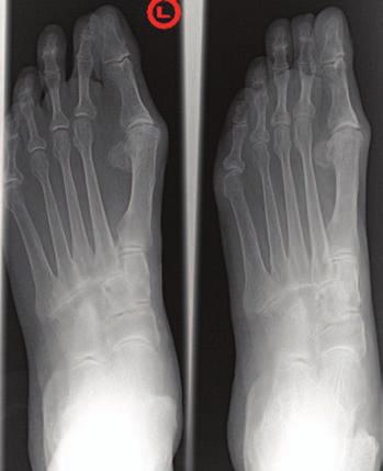 KG is a 69-year-old woman who was referred to me with a flexible flatfoot deformity. She had been treated conservatively and was ambulating in a podiatric ankle foot orthosis on the left side.