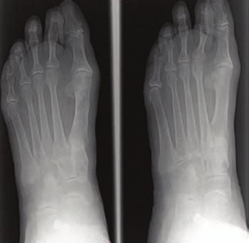 Her main desire was to wear regular shoes without a brace. Her examination was consistent with medial arch collapse on weight bearing (Figure 13).