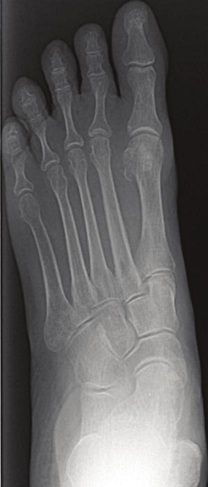 90 CHAPTER 17 Figure 11. Postoperative lateral radiograph.