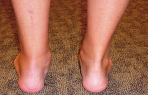 valgus; however, the patient was happy with the results despite