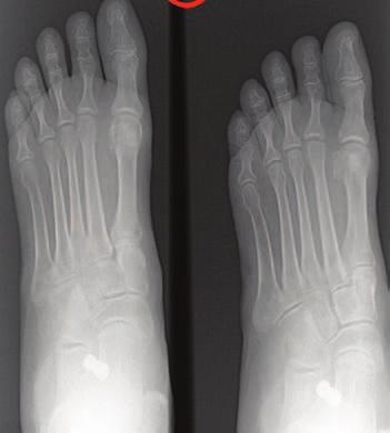 Clinical posterior view depicting the too many toes sign on the